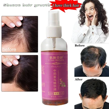 Genuine Anti-fall and Anti-fall Hair Growth Liquid To Prevent Bald Hairline From Growing Quickly In Private Parts and Long Hair