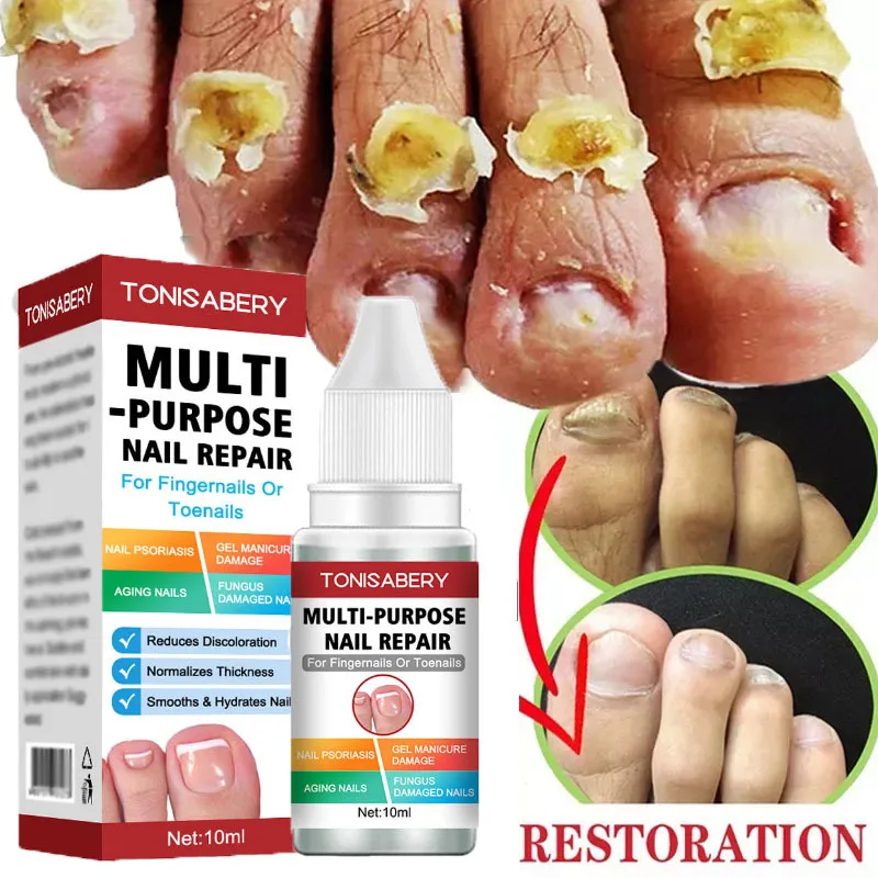 

Fungal Nail Treatment Serum Anti Infection Feet Cuticle Remove Care Essence Onychomycosis Paronychia Toe Nail Fungus Repair Gel