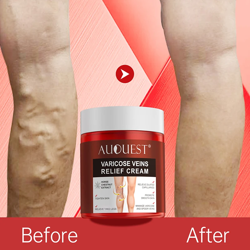 

AUQUEST Varicose Veins Relief Cream Vasculitis Phlebitis Spider Pain Relief Ointment Medical Plaster Body Care 80g