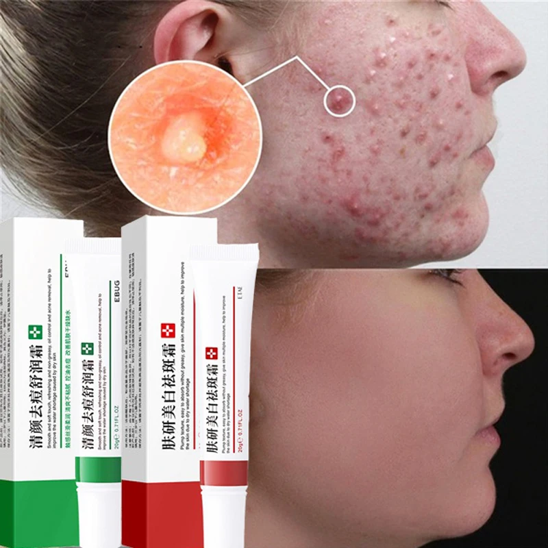 

Acne Treatment Face Cream Repairing Whitening Remove Dark Spots Anti-aging Anti-Acne Oil Control Moisturizing Skin Care Cream