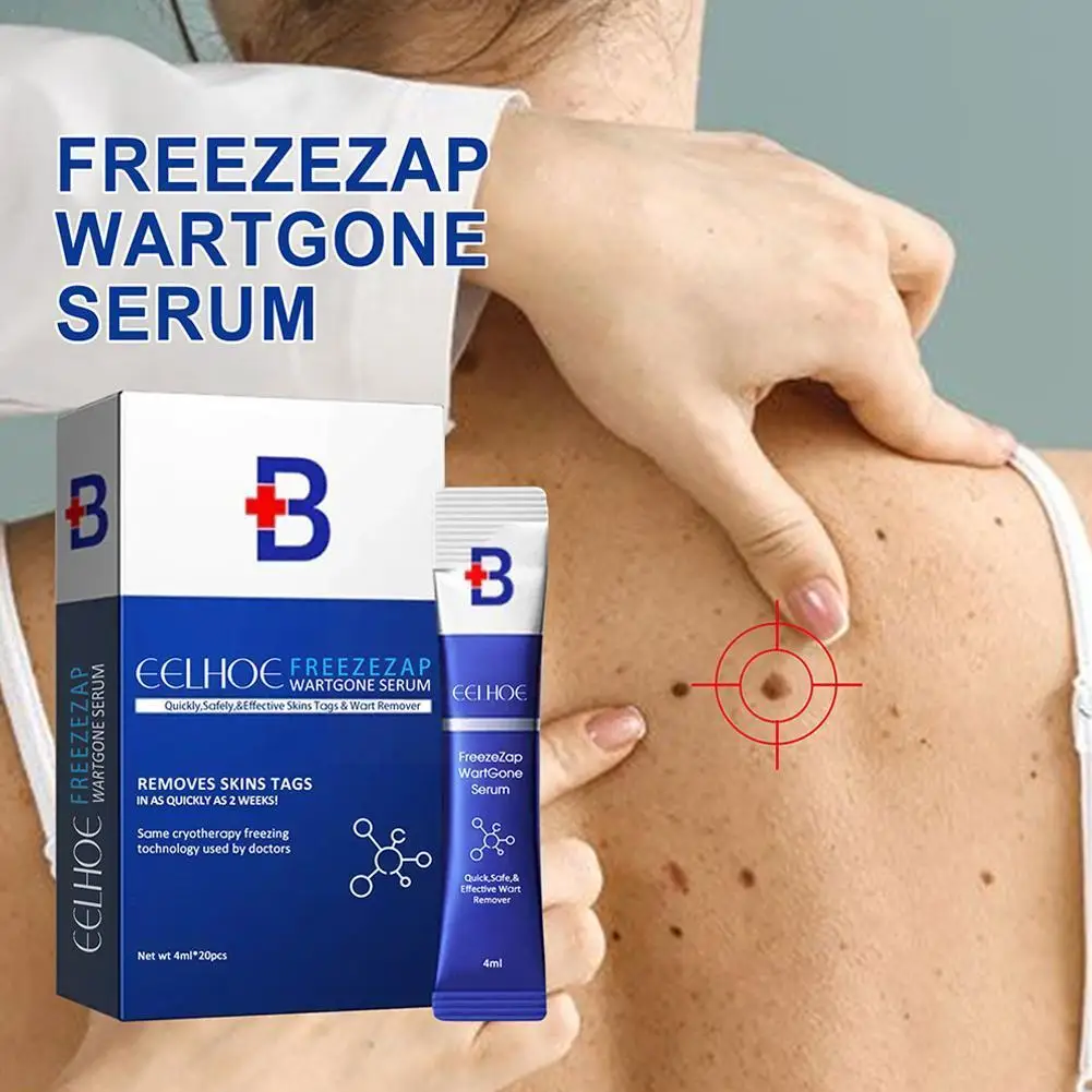 

Professional Skin 4ML/20pcs Wart Removing Stinger Wart Mole Black Warts Nevus Lcd Tattoo Spots Freckle Remover Removal A6Z1