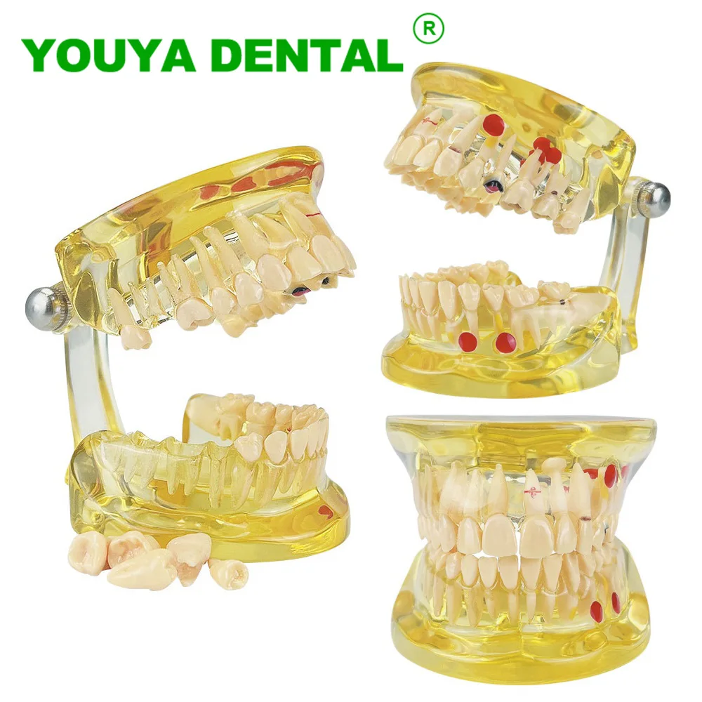 Модель для обучения стоматологии полусъемные зубы патологическая модель