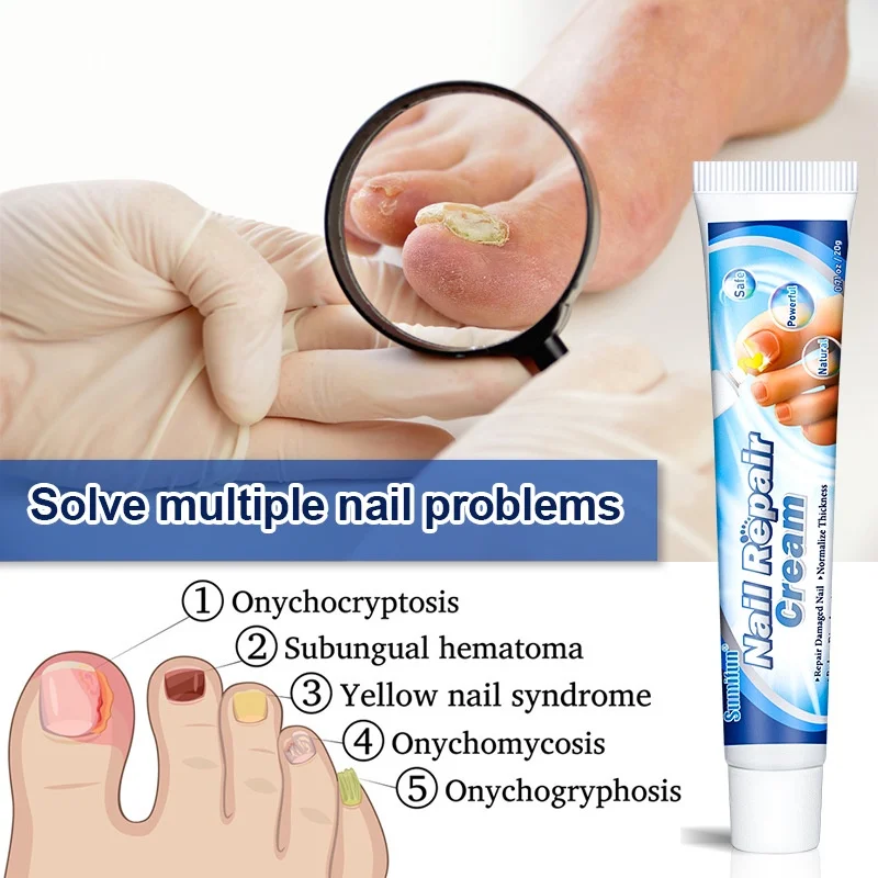 3pcs Nail Fungus Removal Cream Onychomycosis Fungal Nail Treatment Paronychia Anti Infection Feet Toe Fungal Nail Care Ointment