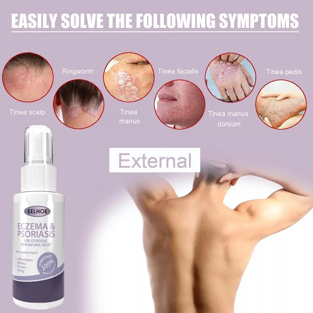 

Herbal Eczema Psoriasis Spray Antibacterial Dermatitis Foot Irritation Itching Athletes Relieve Skin Care Lithospermum