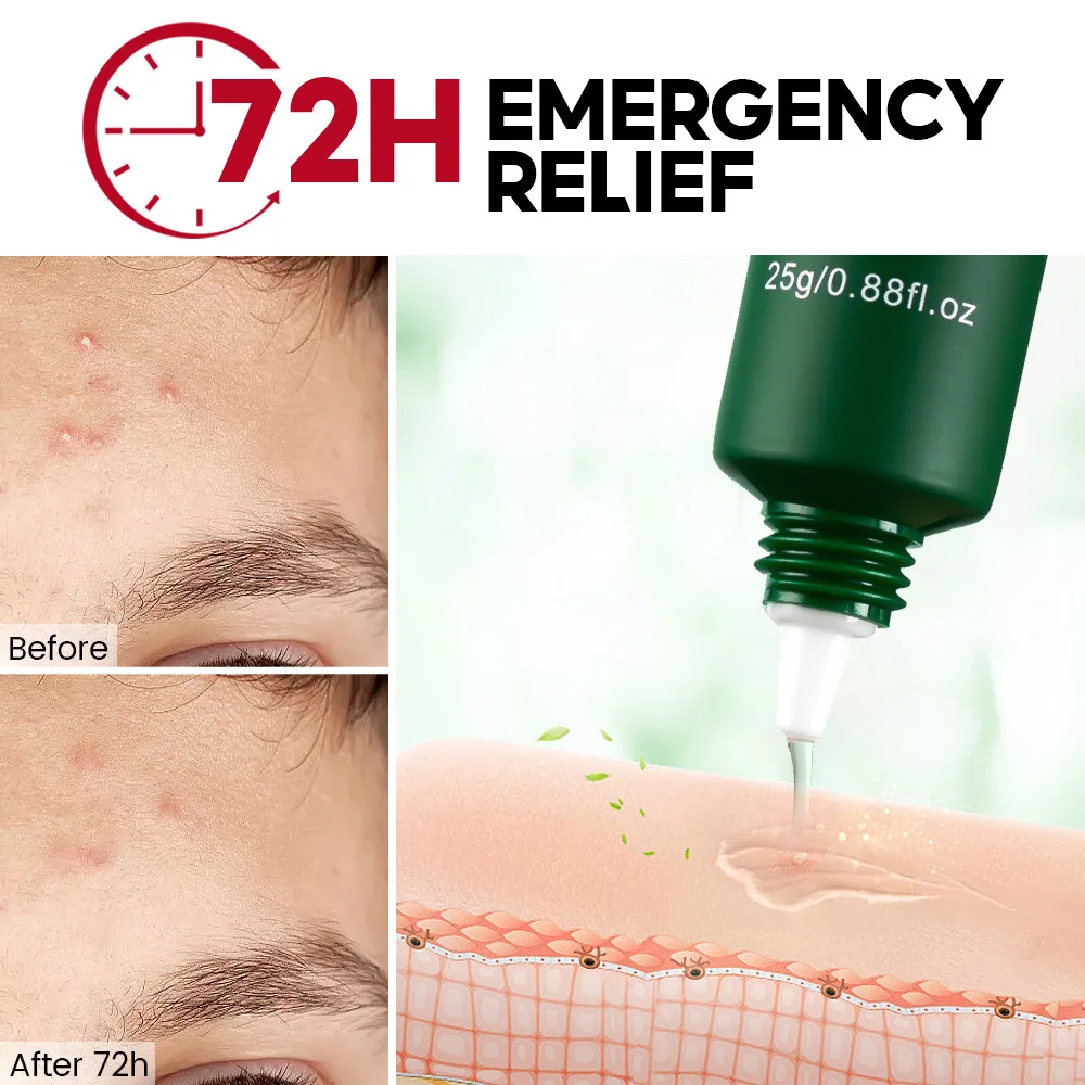 

25g repairing acne marks acne pits acne blackheads shrinking pores redness swelling oil control herbal gel acne cream
