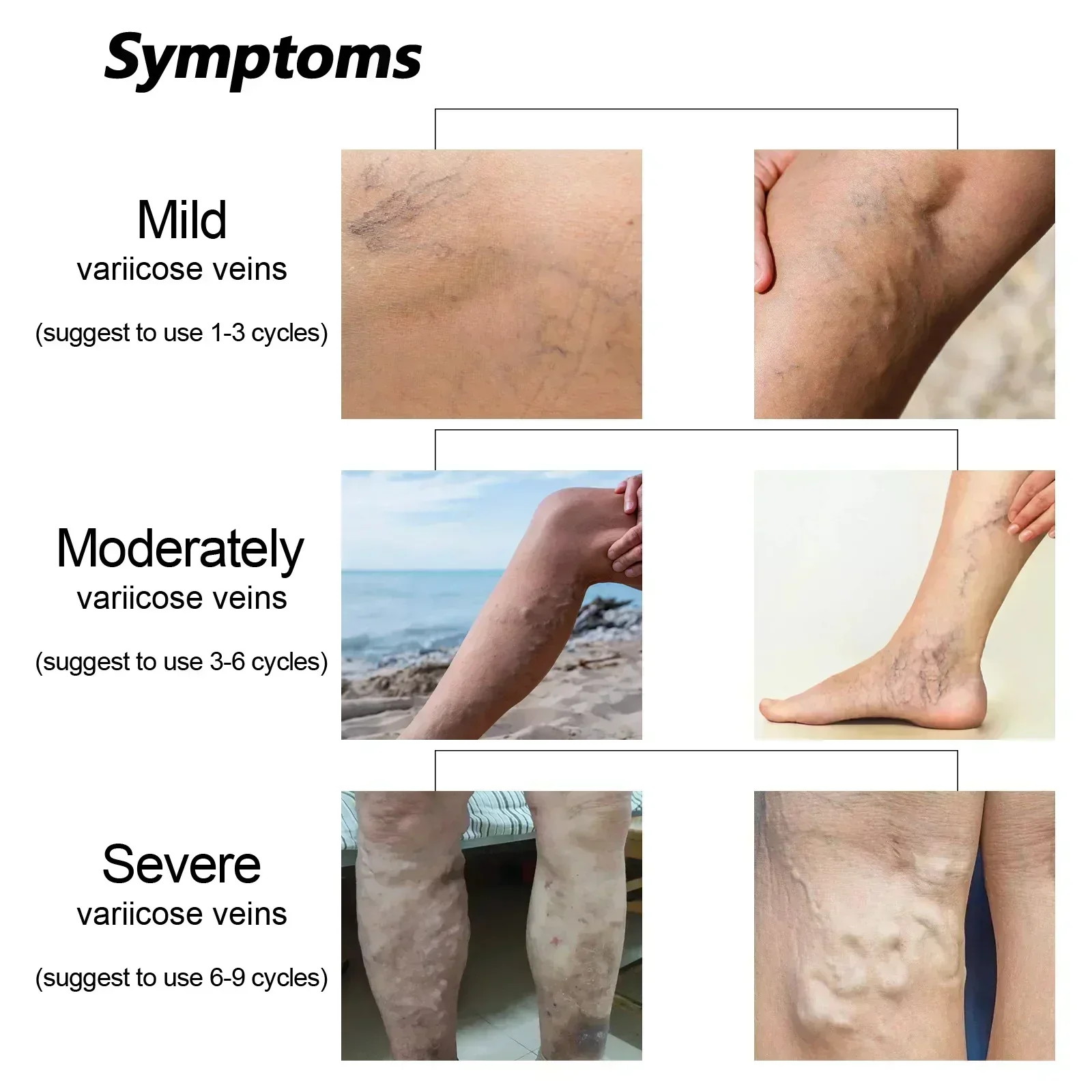 Крем от варикозного расширения вен флебит варистос ангейт пластырь мазь для