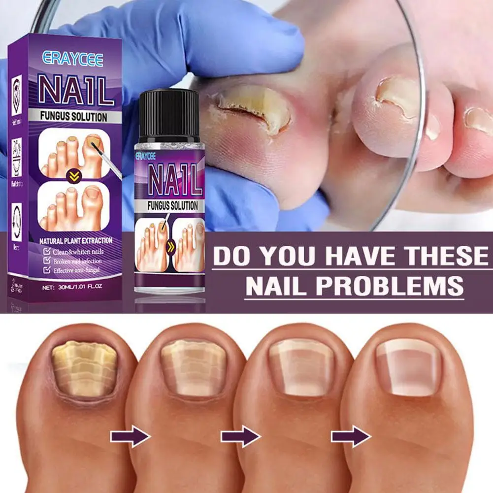 

Nail Fungal Treatment Essence Oil Foot Toe Nail Fungus Removal Serum 7 Days Repair Onychomycosi Anti Infection Gel Care Products