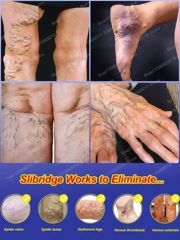 Крем для удаления варикозного расширения вен мазь ухода за телом крем лечения