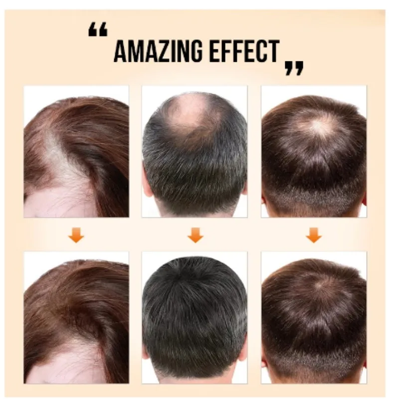 

PURC New Fast Growing Hair Oil Hair Growth Products Baldness Treatment Hair Loss Care Beauty Hairs Serum For Men Women 35ml
