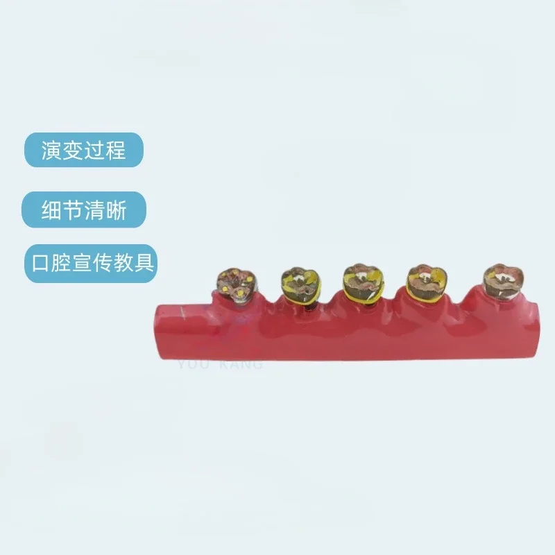 Модель пародонтита смола модель пародонтальной эволюции для взрослых