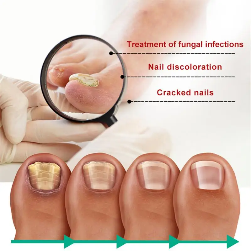 

Nail Fungal Treatment Feet Care Essence Anti Infection Paronychia Onychomycosis Nail Foot Toe Nail Fungus Removal Gel Products