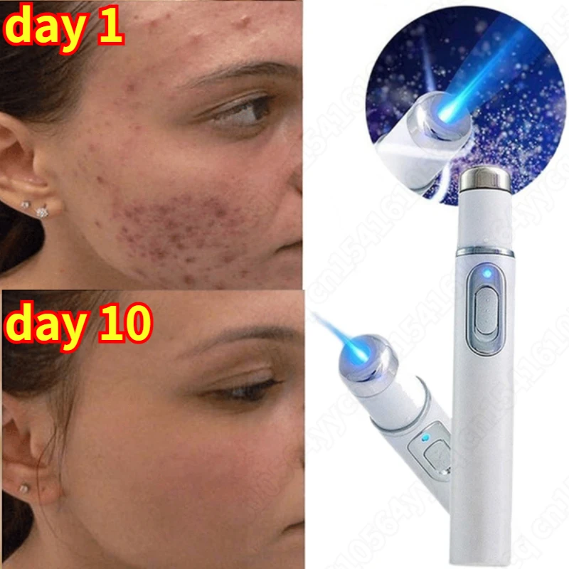 

1 шт., лазерная ручка для лечения варикозного расширения вен