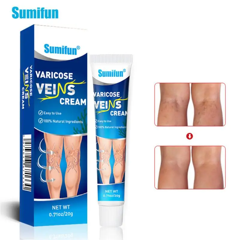 

Effective Varicose Veins Cream Relieve Vasculitis Phlebitis Spider Pain Relief Ointment Herb Plaster Beauty Body Care Skincare