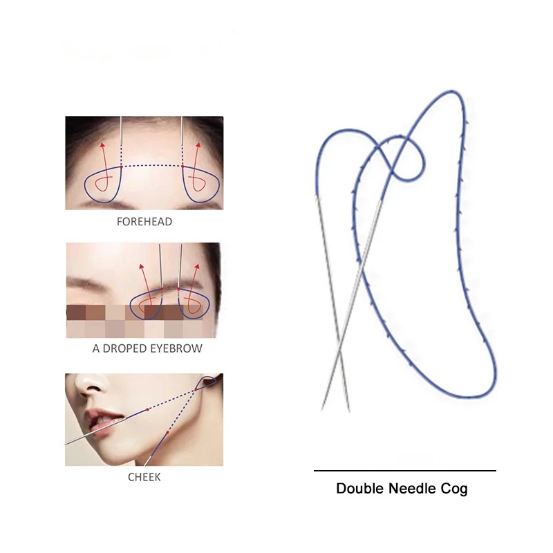 

Pdo Double needle thread pdo fishbone cog lift fio 20G 290mm 380mm for eyebrow lift
