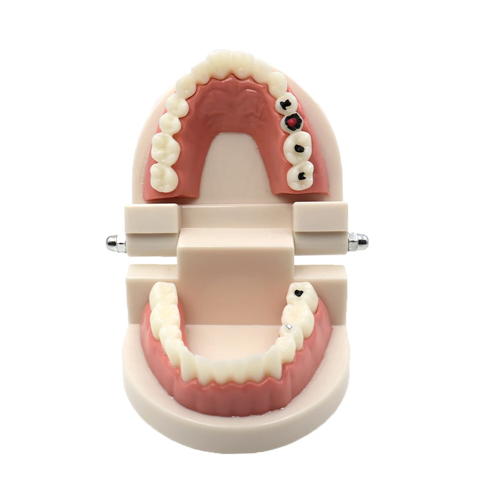 

Dental Caries Tooth Model Education Study Oral Teeth Disease for Teaching Kids