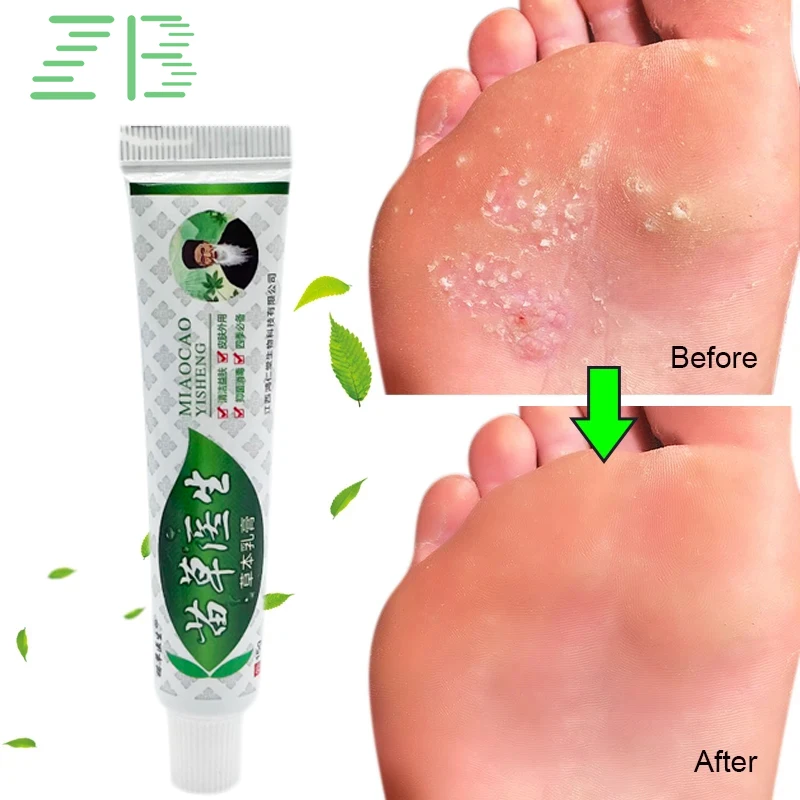 

Мазь берибери для лечения запаха ног, 15 г, китайская медицина, повязка против зуда, ингибирует грибок, пилинг ног, медицинский крем