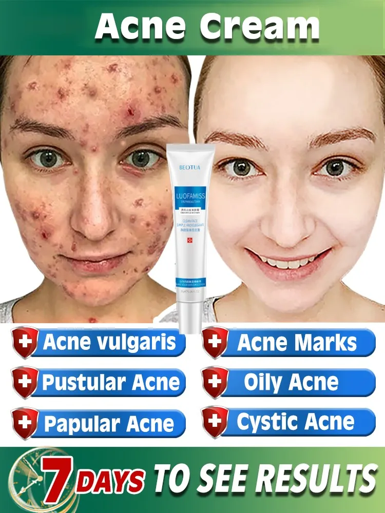 

Acne cream to eliminate acne and acne marks herbal extracts efficient anti-inflammatory skin repair moisturizing oil control