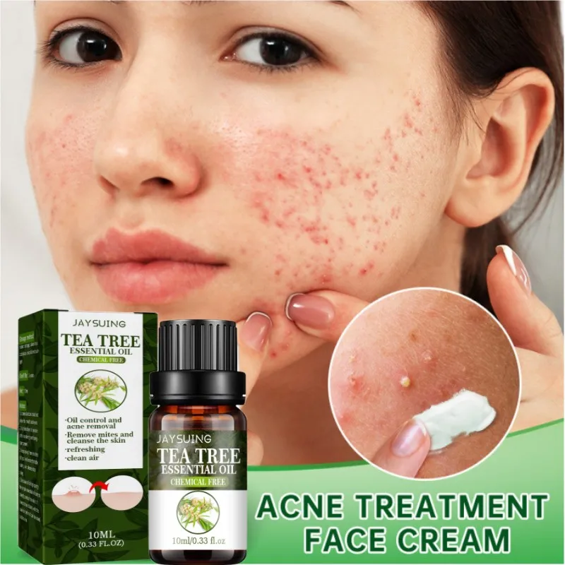 Instant Acne Treatment Serum Removes Acne Pimples Scars Pockmarks Remove Blackheads Shrink Pores Oil Control Smooth Skin Beauty