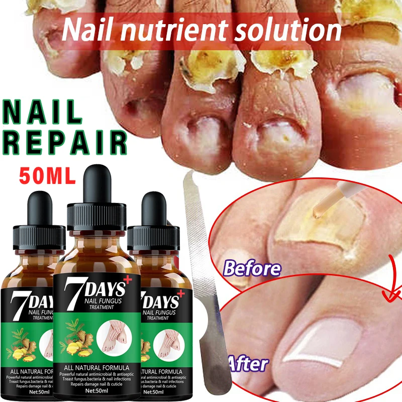 

2022 New Nail Fungus Treatment Essence Serum Care Hand and Foot Care Removal Repair Gel Anti-infective Paronychia Onychomycosis