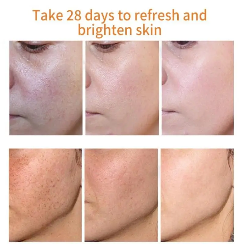 

IBeaLee Whitening Cream Face Freckle Remove Dark Spots Fade Acne Scars Melanin Pigmentation Melasma Anti-Aging Brighten Skin