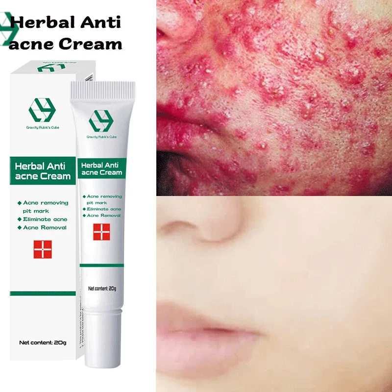 

Herbal Acne Control Acne Cream Scars Pore Reduction Oil Control Moisturizing Face Cream Acne Skin Care
