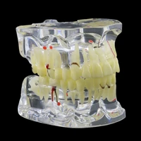 adult teethtransparent pathological tooth model dental cariesapical cyst tartar implant tooth model4001