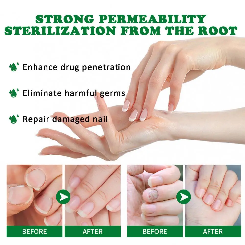 Efficient Heals Dry Cracked Cuticles Nail Renewal Liquid Nail Treatment Liquid Effective  Nail Care images - 6