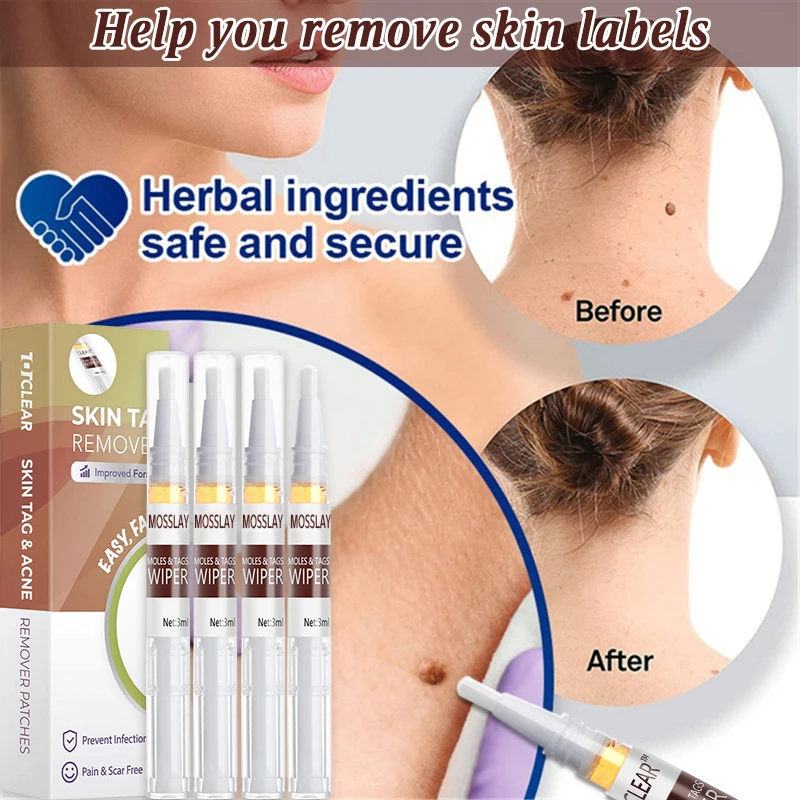 

MOSSLA Removing Against Moles Liquid Pen Treatment Papillomas Removal of Warts Liquid From Skin Tags Remover Anti VerrucaRemedy