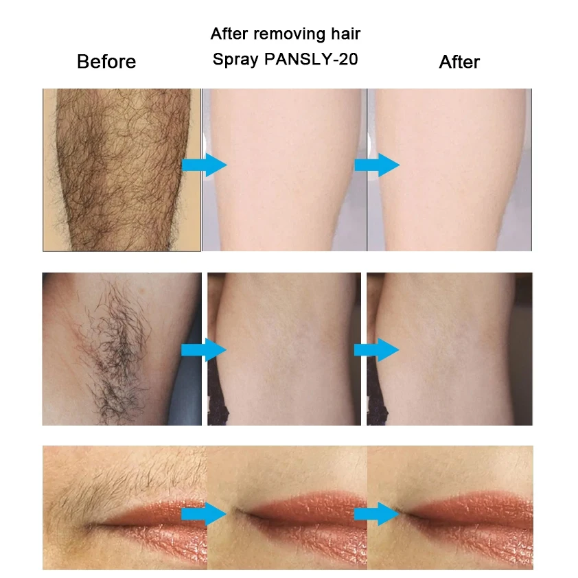 Крем для удаления ингибитора роста волос борода бикини интимное лицо ноги тело