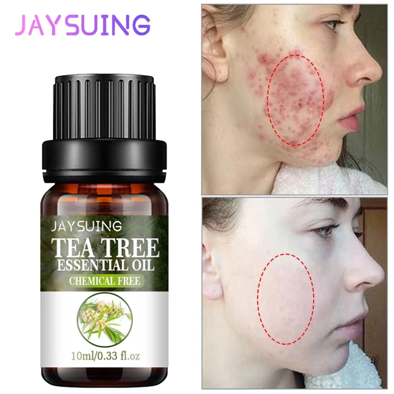 

Tea Tree Acne Removal Essential Oil Serum Fade Acne Spots Pimple Oil Control Cream Whitening Moisturizing Brighten Skin Care