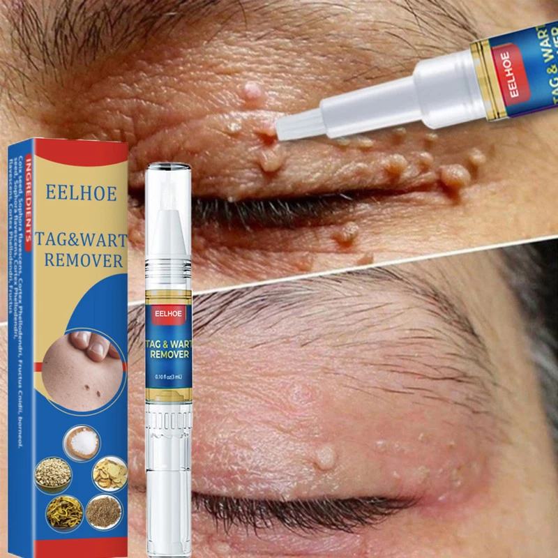 

Skin Tag Remover Pen Essential Oil Painless Mole Dark Spot Warts Freckle Treatment Serum Whitening Smoothing Face Body Skin Care