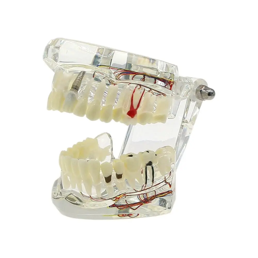 Dental Implant Disease Teeth Model Neural Repair Pathological Removable Teeth dental floss tooth pick outils de nettoyage