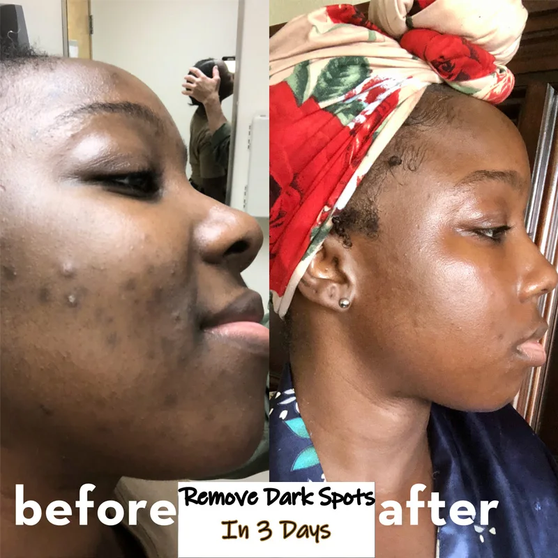 

Куркуминоиды удаляют выцветание темные пятна куркума корректор Маски Для Лица Увлажняющий Осветляющий следы от акне осветляет тон кожи Мя...