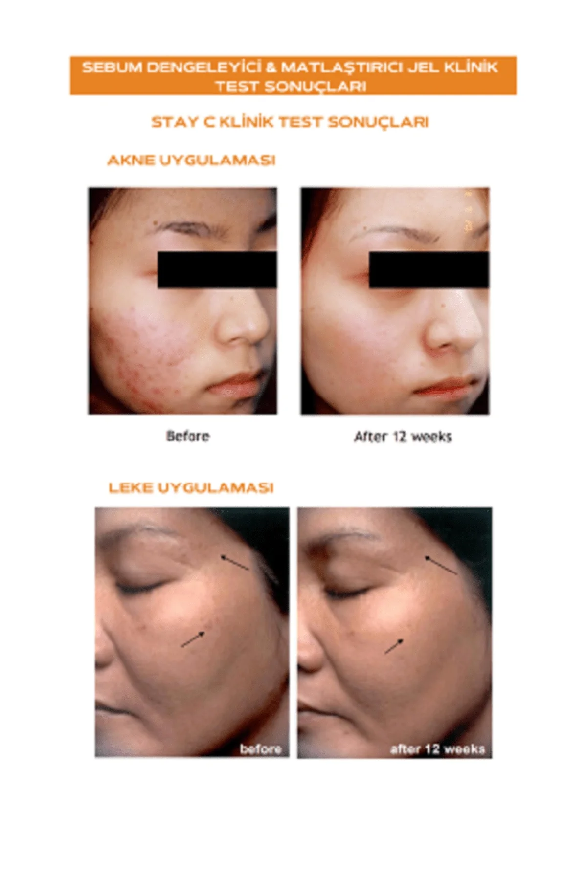 Producto 100% Original y rejuvenecedor, equilibrador de sebo, Matizante, viene (crema para acn&eacute;), muy &uacute;til-3