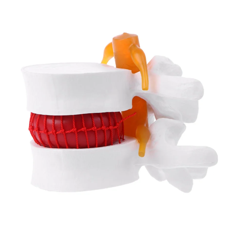 

Earth Tones Human Spine Model Anatomy Pvc Lumbar Disc Herniation Presentation Depuy medical