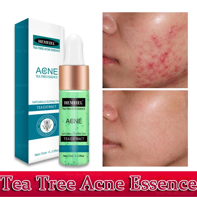 

Tea Tree Acne Essence Dilutes Acne Marks, Removes Acne Blackheads, Improves Acne Muscle, Oil Control, Moisturizes Face Serum