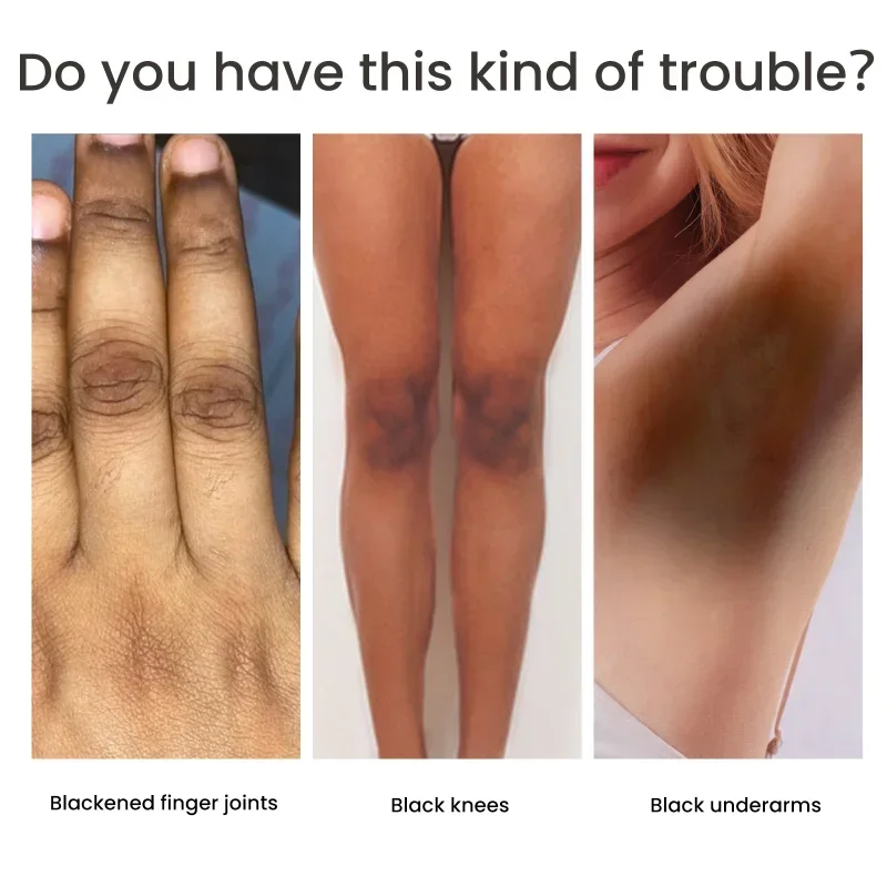 Отбеливающий крем Sdotter для суставов тела подмышек ног коленей локтей Осветляющий