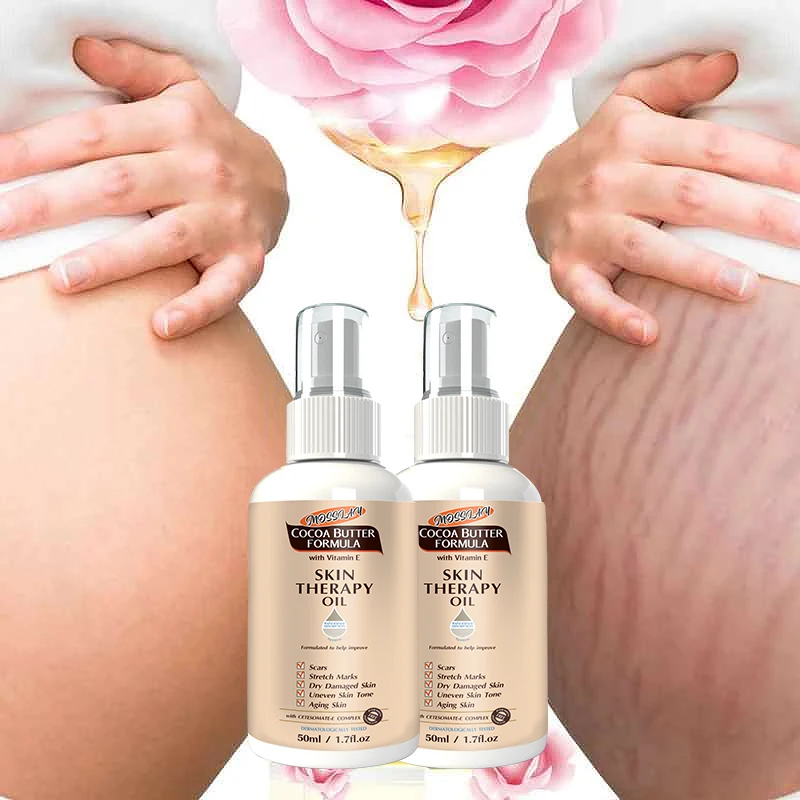 

Stretch Mark Spray Repair Removal Acne Scar Stretch Marks Cream Fat Scar Striae Gravidarum Treatment Streaks Obesity
