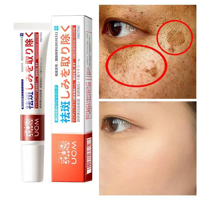 Freckles Remove Face Cream Whitening Brightening Removal Black Spots Fade Melasma Lighten Melanin Improve Dull Skin Care Product