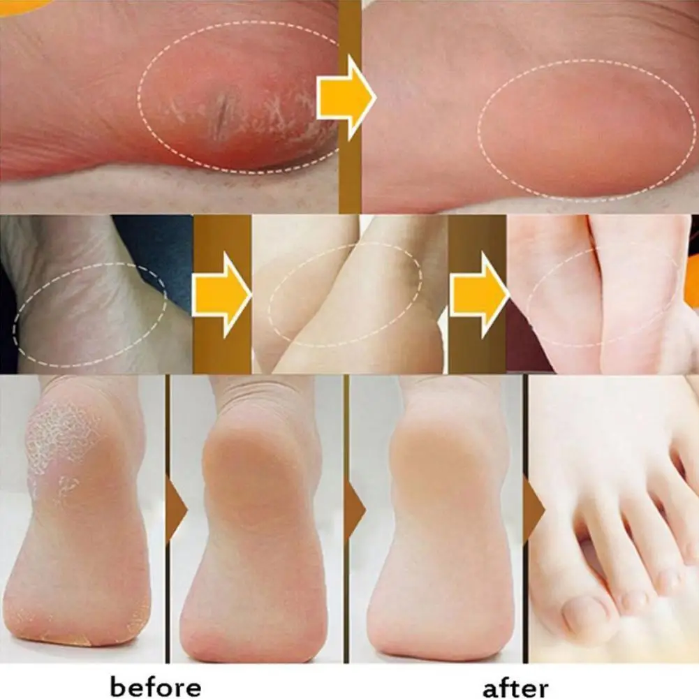 

Repair Hand Cream Anti-drying Heel Cracked Repair Herbs Hand Feet Foot Cream Care Removal Crack Dead Skin W4p0