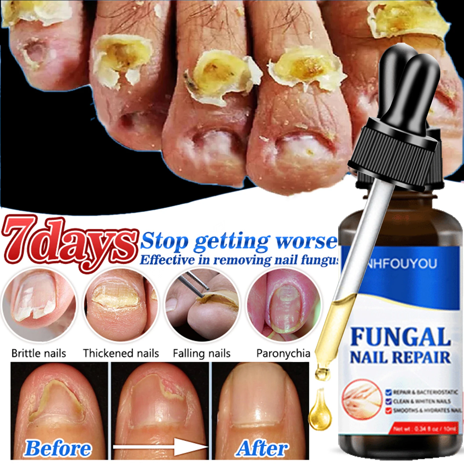

Fungal Nail Treatment Oil Foot Repair Essence Toe Nail Fungus Removal Gel Anti Infection Cream Fungal Nail Removal 10ML