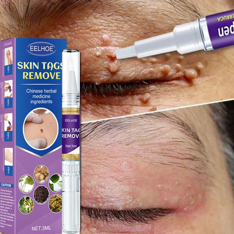 

Skin Tag Remover Liquid Pen Wart Papilloma Flat Warts Removal For Genital Painless Serum Dark Spot Freckle Face Treatment Cream