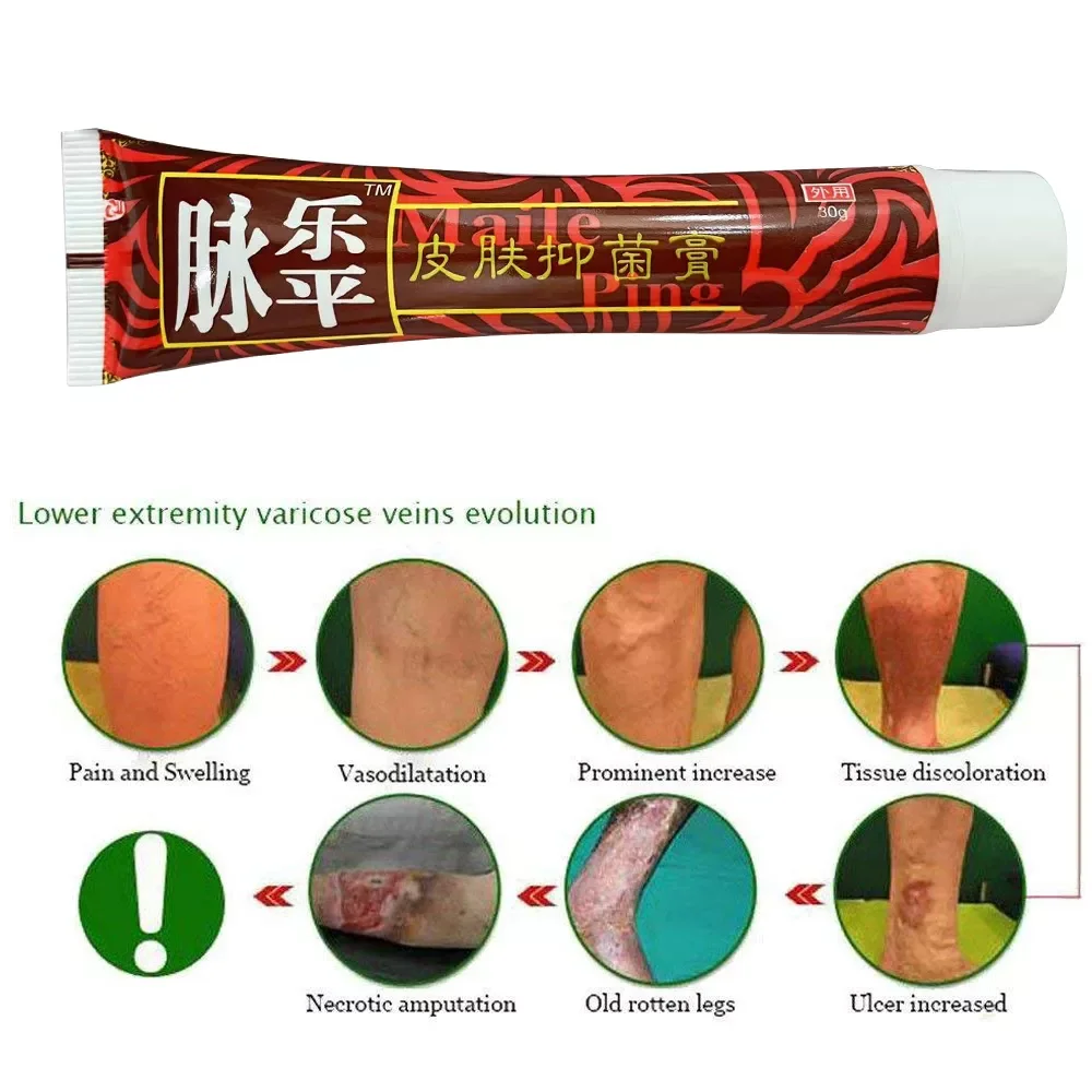 Лечение Варикозного расширения вен варикозное ангиитное средство мазь для