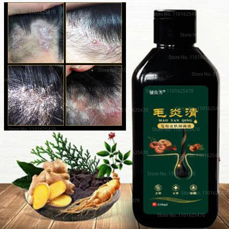 

Hair Psoriasis Seborrheic Skin Care Treatment Dermatitis Eczema Compound Herbal Shampoo,Anti-itch, Anti-dandruff, Oil Control