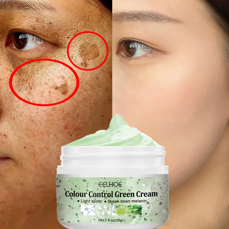 Effective Whitening Freckle Face Cream Remove Dark Spots Melasma Fade Melanin Pigmentation Anti-Aging Brighten Beauty Skin Care