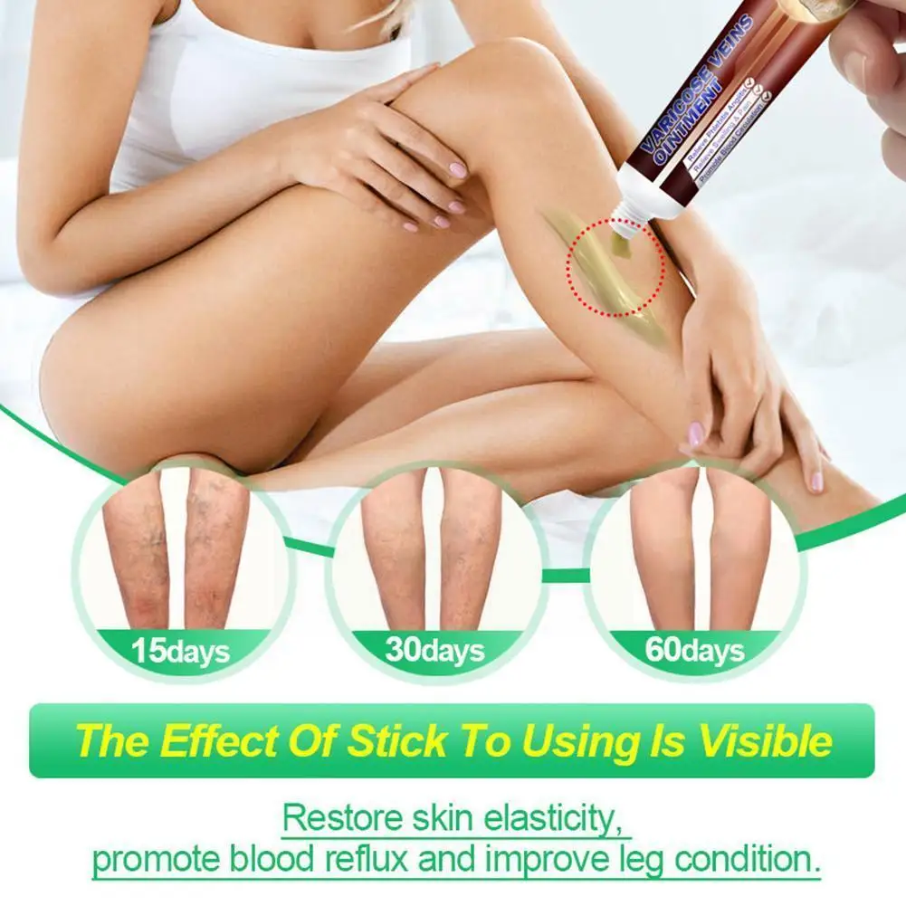 

1pcs Varicose Veins Treatment Cream Swollen Blood Vessels Vasculitis Spider Varicocele Ointment Cream Cream Varices Veins T1F7