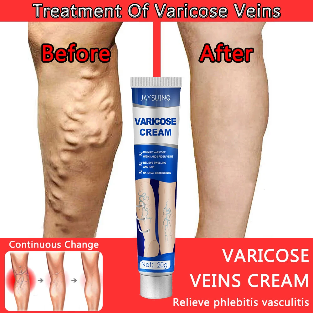 

Effective Varicose Vein Relief Cream Ointment For Varicose Veins To Relieve Vasculitis Phlebitis Spider Pain Treatment