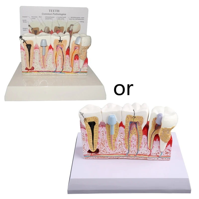 

7x5.9x5.1in Model Teeth for Dental Education Supplies Tooth Pathology Display
