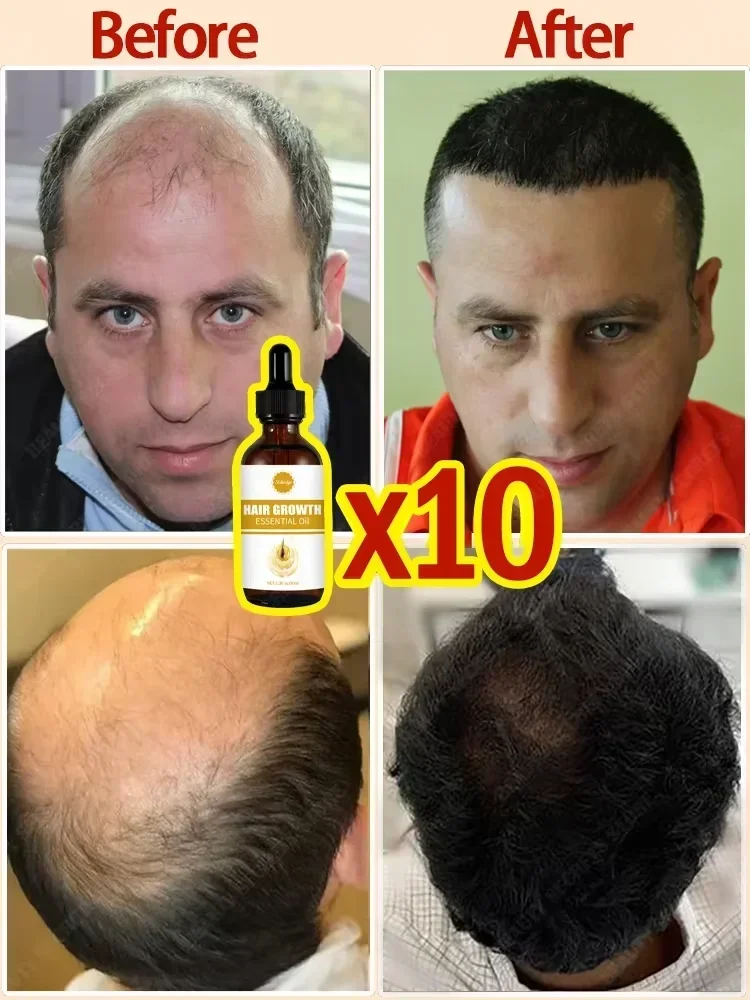 Óleo de crescimento rápido do cabelo para produtos homens mulheres