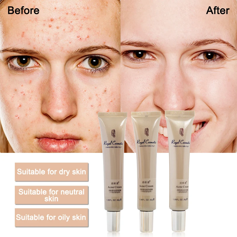 Rungenyuan Anti-acne cleansing cream 30g Facial scrub melatonin lotion skin care emulsion acne marks remove Oily skin Hydrate